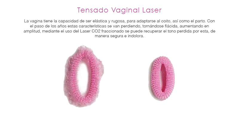 Tensado Vaginal Laser